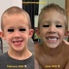 CAN'T DENY A MAMA BEAR 🐻 // This isn't “Instagram influencer” dentistry.  This case was completed TODAY and these photographs were put together by  this child's mother (I just blocked out the