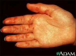 There are two different forms of blood spots under the skin. Vasculitis On The Palm Medlineplus Medical Encyclopedia Image