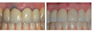 Chances are, clearchoice will charge something in this range. Metal Free Dental Implants New York Zirconia Dental Implant Specialists