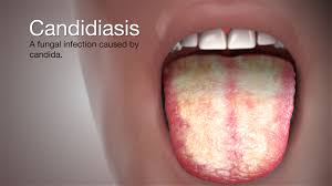 Image result for Candidiasis