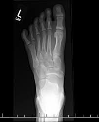 I Have 6 Toes On My Left Foot Here S The X Ray R Mildlyinteresting Mildly Interesting Know Your Meme
