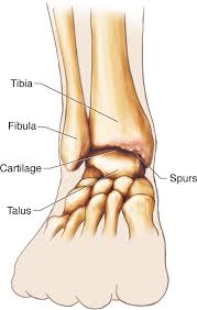 This bone is part of the fibula, one of two bones of the lower leg; Lower Leg And Ankle Injuries Musculoskeletal Key