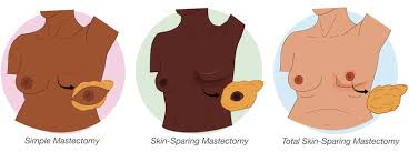 Image result for Mastectomy