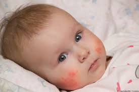Zeichen es verbunden ist, ist allerdings gänzlich verschieden. Roter Ausschlag Beim Baby Durch Zahnen Im Gesicht Wiado De