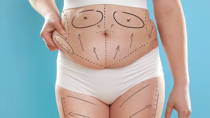 Liposuction Cost Guide in Charles County, Maryland—What to Expect from  Pricing and Fees - Mid-Atlantic Skin Surgery Institute