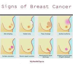 Breast cancer symptoms in women over 50 include: 22 Paget S Disease Ideas Pagets Disease Paget Disease