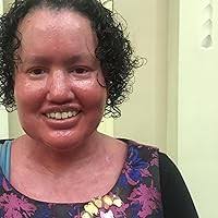 A Face for Picasso: Coming of Age with Crouzon Syndrome by Ariel Henley