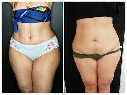 L'abdominoplastie ou chirurgie du ventre. Chirurgie Esthetique Du Ventre Corps Dr Nicolas Zwillinger