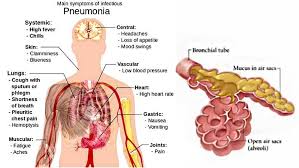 Astrology Medical Astrology Community Acquired Pneumonia Pneumonia
