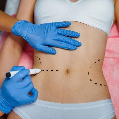 How Long Is Bed Rest After Liposuction ?