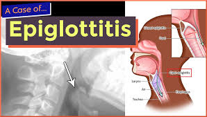 Image result for Epiglottitis