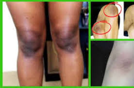 After 20 to 30 minutes wash off the area. Get Rid Of Stubborn Dark Knees Without Medicatiom