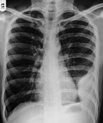 This is typically a chronic process. Loculated Pleural Effusion Radiology Case Radiopaedia Org