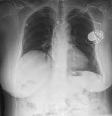 Bilateral generators and single lead deep brain stimulators. Blood Pressure And Glucose Control May Prevent Common Arrhythmia Uc San Francisco