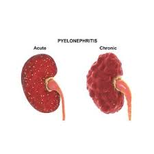 Image result for Acute Pyelonephritis