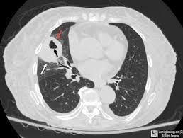 Image result for Lung Abscess