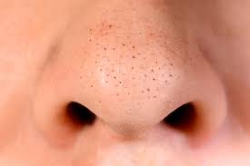 Cara menghilangkan jerawat dengan menggunakan lidah buaya untuk menghilangkan jerawat 3. Kenali Penyebab Dan Cara Mengatasi Blackhead Alodokter