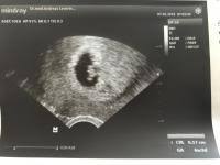 Heute Erster Ultraschall 6 3 Und Schlagt Forum Schwangerschaft Urbia De
