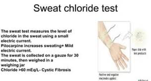 Image result for Sweat Chloride