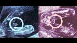 Es kann eine vermessung des embryos erfolgen zu dem zweck, festzustellen, seit wann die patientin schwanger ist. Madchen Im Ultraschall Babywelten Ch