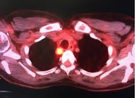 So it's important to know its symptoms when it has become advanced. Papillary Thyroid Cancer Overview Symptoms Treatments And Prognosis For Papillary Thyroid Carcinoma