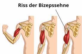 Bizepssehnenriss Riss Der Bizepssehne Richtig Behandeln