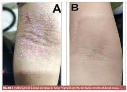 Tribulus is a plant that produces fruit covered with spines. Evaluation Of Botulinum Toxin A As An Optional Treatment For Atopic Dermatitis Jcad The Journal Of Clinical And Aesthetic Dermatology