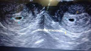 Saco Gestacional Medindo 6 6mm 4 Semanas Tentando Engravidar Principal Babycenter