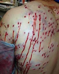 Shotguns launch shot in a string. This Is What Being Shot With A Bird Shot Shotgun Shell Looks Like After A Burglary Went Bad For The Bad Guy Medizzy