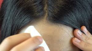 Por Que Salen Granitos En La Frente Como Puedes Evitarlo Video