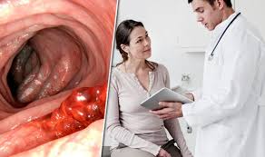 Gastroenterologists dr jeff butterworth explains everything you need to know about bowel cancer, including causes, symptoms, and treatment Bowel Cancer Breakthrough New Treatment Is First Non Toxic Therapy Express Co Uk