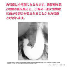 角切痕は 弯 側にみられる 解答 小弯 角切痕は小弯側にみられます 造影剤を飲みx線写真を撮ると 小弯の一部に急角度に曲がる部分が見られることから角切痕と呼ばれます 解剖学 小弯 lesser curvature 角切痕 gastric cancer cancer medical