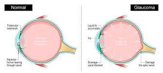Image result for Intraocular Pressure