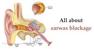 Earwax Plays An Important Role In Protecting The Ear But If The Earwax Is Not Cleant Properly It Develops Infections Ca Ear Wax Ear Wax Buildup Middle Ear