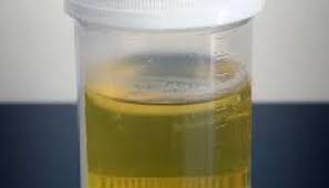 Kencing kotor boleh disebabkan oleh jangkitan kuman pada tempat buang air. Perlukah Rawatan Antibiotik Jika Pemeriksaan Air Kencing Menunjukkan Air Kencing Kotor Dr Zubaidi Hj Ahmad Menulis