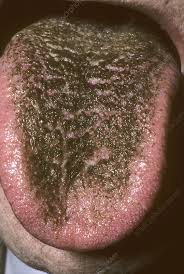 Image result for black hairy tongue symptoms