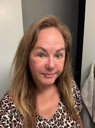 Dental Surgery Experience with No Pain or Bruising