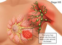 Although breast cancer can spread to any bone, the most common sites are the ribs, spine, pelvis, and long bones in the arms and legs. Breast Cancer Signs Symptoms Stages Treatment About Risk Factors Ashray
