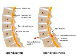 Spondylolysis Spondylolisthesis Spinal Stenosis Stress Fracture