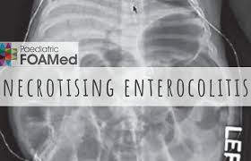 Image result for Necrotizing Enterocolitis