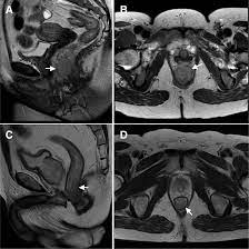 Synchronous anal canal carcinoma in a heterosexual couple | BMC Cancer |  Full Text