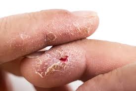 Image result for dermatitis contacta allergica