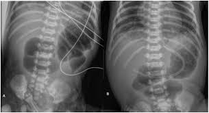 Image result for Intestinal Atresia