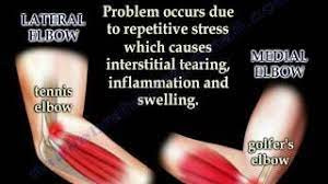 However, this injury is far from being exclusive only to golfers. Tennis Elbow Golfer S Elbow Everything You Need To Know Dr Nabil Ebraheim Youtube