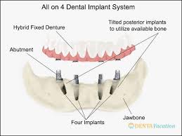 All On 4 Dental Implants Abroad Dental Implants Cost Cosmetic Dentistry Dental Implants Cost Dental Implants