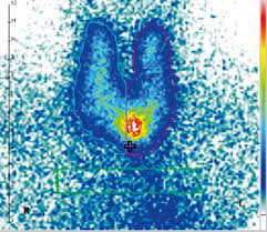 Der heiße knoten ist ein bereich der schilddrüse, der das radiopharmakon intensiv speichert. Schilddrusenszintigraphie Ulm