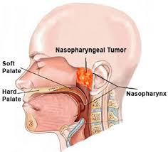 I am also worried about throat cancer. Nose And Throat Cancers Ent Specialist Singapore