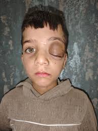 مضى 6 ساعات ولا تزال اسراء داخل صالة العمليات من أجل إجراء العملية الثامنة  دعواتكم لها أن تخرج مكللة بالنجاح هذا العملية تعد اصعب عملياتها وأكثرها  خطورة وبنسبة نجاح ضعيفة جداً واحتمالية