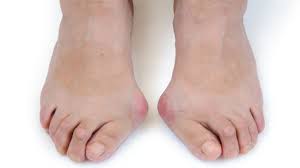 Kebiasaan cara berjalan yang salah bisa menimbulkan tekanan berlebih di area tertentu saja dan itulah yang obat berbentuk plester juga bisa menyembuhkan penyakit ini dengan menarik kulit yang terinfeksi. Inilah Cara Menghilangkan Bunion Tanpa Operasi