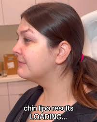 When your chin lipo results are so good you get an article written about  you… 😱🤭, Thank you so much to @carinahsieh for featuring my patient’s  results in @thedailybeast @thelookertdb , #chinlipo ...